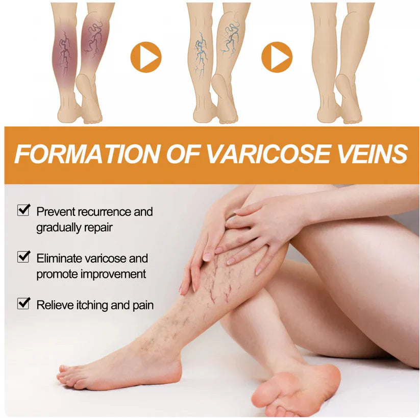 Turmeric Varicose Vein Relief Spray Buy 1 Get 1 Free