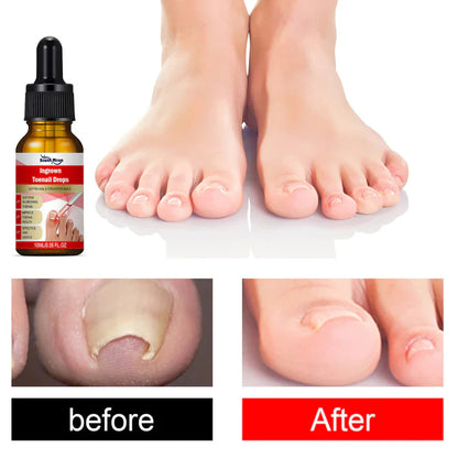 SouthMoon Ingrown Toenail Drops Nail Fungal Repair( BUY 1 GET 1 FREE)